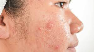 How to Reduce Redness of Acne Scars